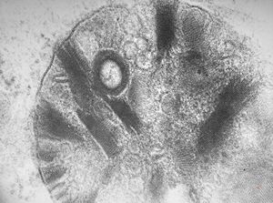 M,27y. | sea-blue histiocyte syndrome